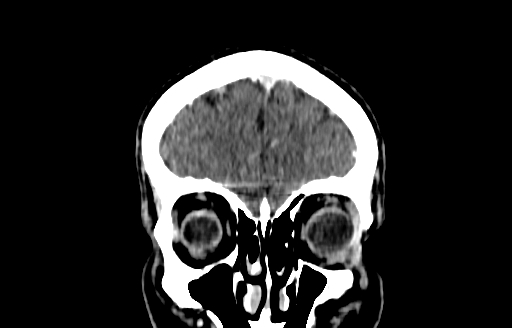 Cerebral venous thrombosis (CVT) (Radiopaedia 77524-89685 C 7).jpg
