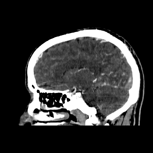 File:Cerebral venous thrombosis (CVT) (Radiopaedia 77524-89685 Sagittal CTV 18).jpg