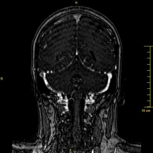 Cerebral venous thrombosis (Radiopaedia 23288-23351 MRV 118).JPG