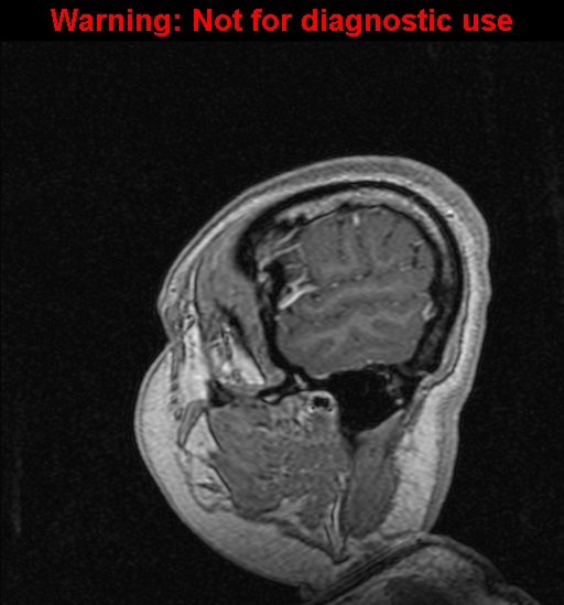 Cerebral venous thrombosis (Radiopaedia 37224-39208 Sagittal T1 C+ 18).jpg