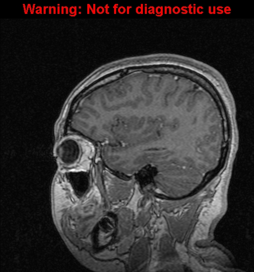 Cerebral venous thrombosis (Radiopaedia 37224-39208 Sagittal T1 C+ 41).jpg