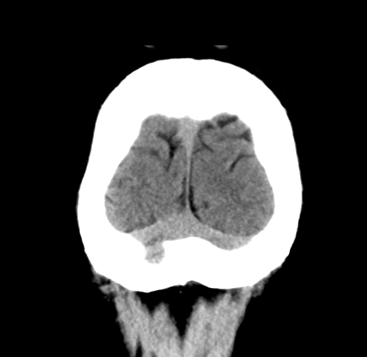 File:Cerebral venous thrombosis (Radiopaedia 38392-40467 Coronal non-contrast 34).png