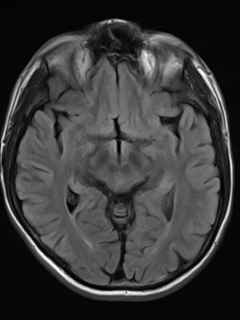 File:Cerebral venous thrombosis (Radiopaedia 38392-40469 Axial FLAIR 11).png