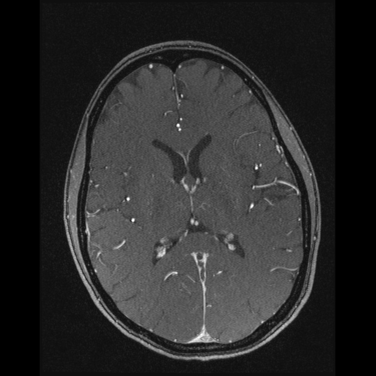Cerebral venous thrombosis (Radiopaedia 45678-49854 Axial MRV 41).jpg