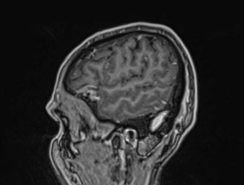 Cerebral venous thrombosis (Radiopaedia 71207-81504 Sagittal T1 C+ 56).jpg