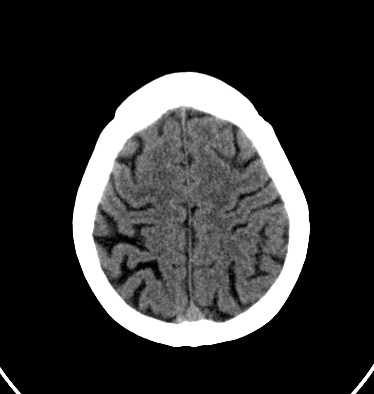 Cerebral venous thrombosis - CT only (Radiopaedia 41031-43778 Axial non-contrast 12).jpg