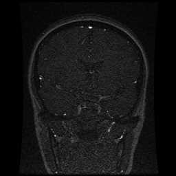 Cerebral venous thrombosis - ulcerative colitis (Radiopaedia 66049-75219 Coronal MRV 70).jpg