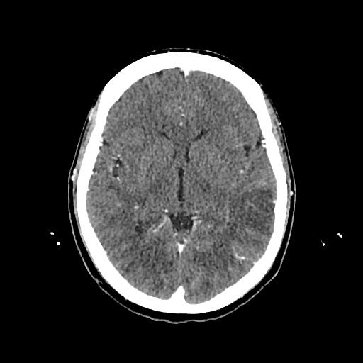 File:Cerebral venous thrombosis with venous hemorrhagic infarct (Radiopaedia 90354-107660 Axial with contrast 81).jpg