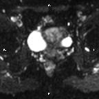 Cervical adenocarcinoma (Radiopaedia 65011-73985 Axial DWI 37).jpg