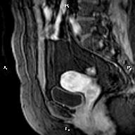 File:Cervical adenocarcinoma (Radiopaedia 65011-73985 E 12).jpg