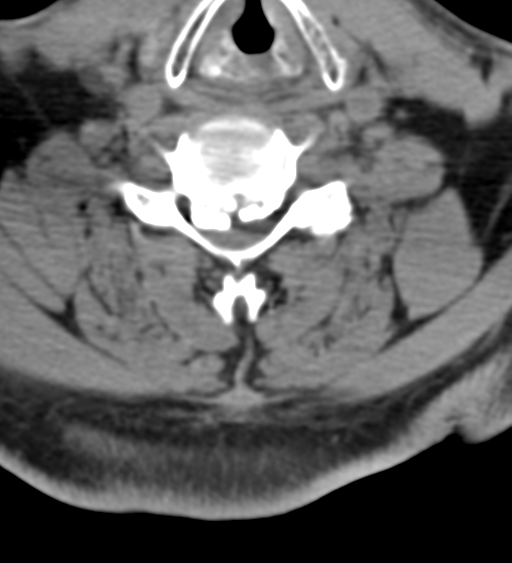 File:Cervical canal stenosis - OPLL and osteophytes (Radiopaedia 47329-51910 Axial non-contrast 39).png