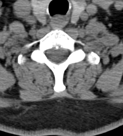 File:Cervical canal stenosis - OPLL and osteophytes (Radiopaedia 47329-51910 Axial non-contrast 48).png