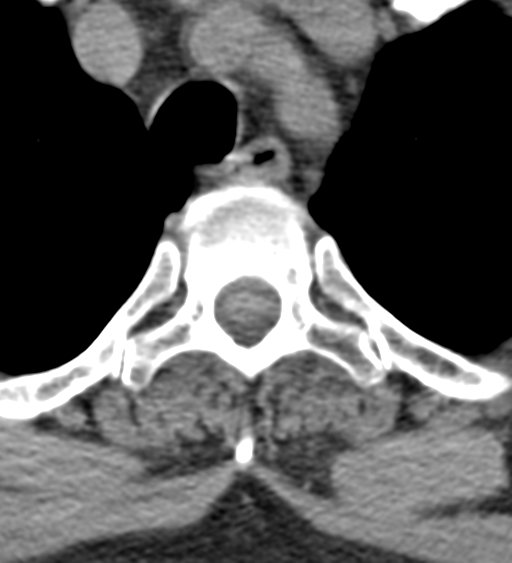 File:Cervical canal stenosis due to ossification of the posterior longitudinal ligament (Radiopaedia 47260-51823 Axial non-contrast 66).png