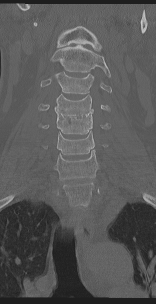 Cervical canal stenosis due to ossification of the posterior longitudinal ligament (Radiopaedia 47260-51823 Coronal bone window 19).png