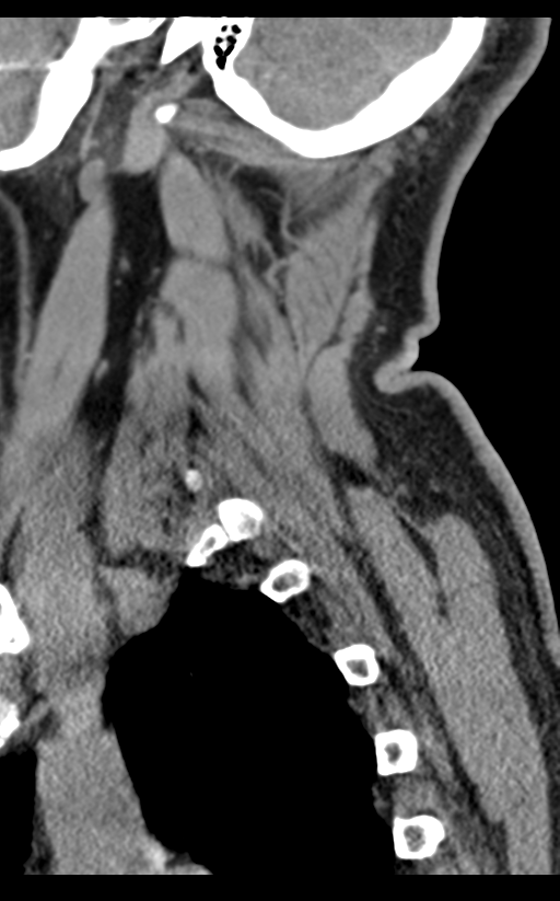 Cervical canal stenosis due to ossification of the posterior longitudinal ligament (Radiopaedia 47260-51823 D 68).png