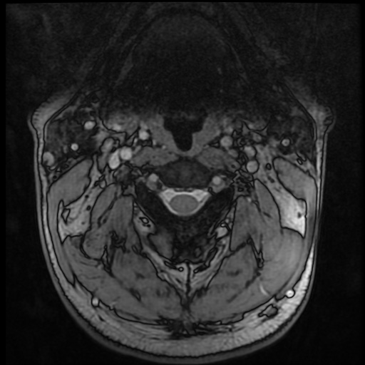 Cervical disc extrusion (Radiopaedia 59074-66364 G 9).jpg