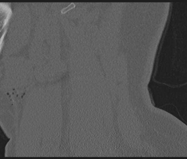 Cervical disc replacement (Radiopaedia 44025-47541 Sagittal bone window 70).png