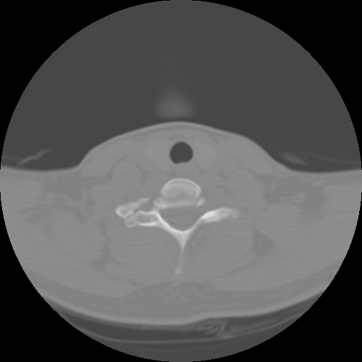 Cervical rib (Radiopaedia 71110-81363 Axial non-contrast 42).jpg