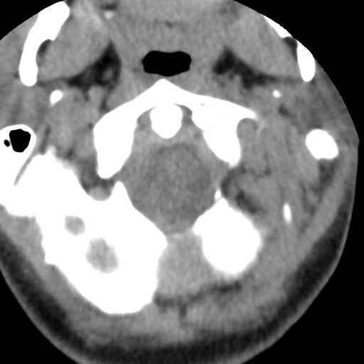 Cervical schwannoma (Radiopaedia 57979-64974 Axial non-contrast 13).png