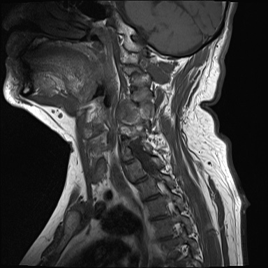 File:Cervical spinal neurofibroma in a patient with NF1 (Radiopaedia 58344-65465 Sagittal T1 9).jpg