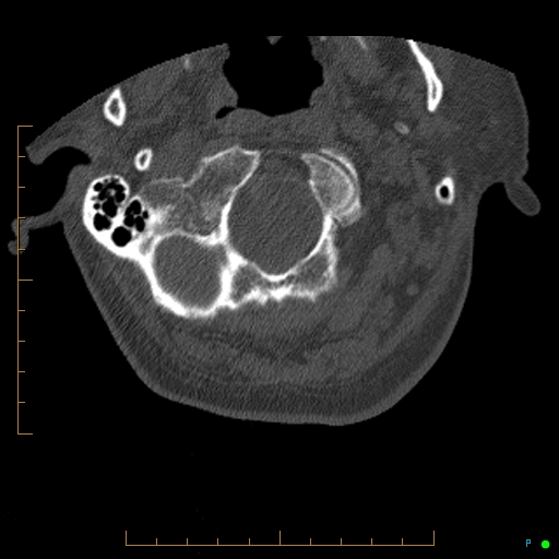 Cervical spine fracture - ankylosing spondylitis (Radiopaedia 76835-88706 Axial bone window 10).jpg