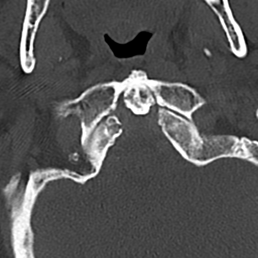 File:Cervical spine fracture - chalk stick (Radiopaedia 39116-41323 Axial bone window 13).png