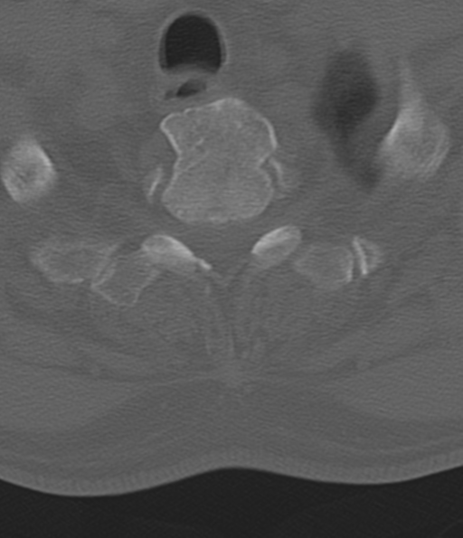 File:Cervical spine fracture in the setting of ankylosis (Radiopaedia 37038-38715 Axial bone window 54).png