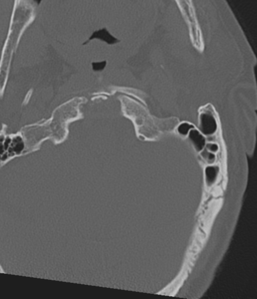 Cervical spine fracture in the setting of ankylosis (Radiopaedia 37038-38715 Axial bone window 9).png