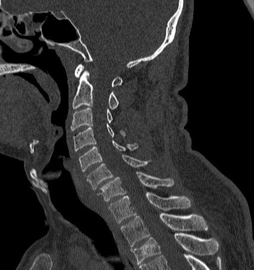 Cervical spine trauma with tear drop fracture and perched facet joint (Radiopaedia 53989-60127 Sagittal bone window 74).jpg