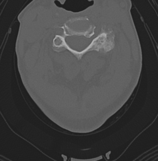 File:Cervical spondylolysis (Radiopaedia 49616-54811 Axial bone window 26).png