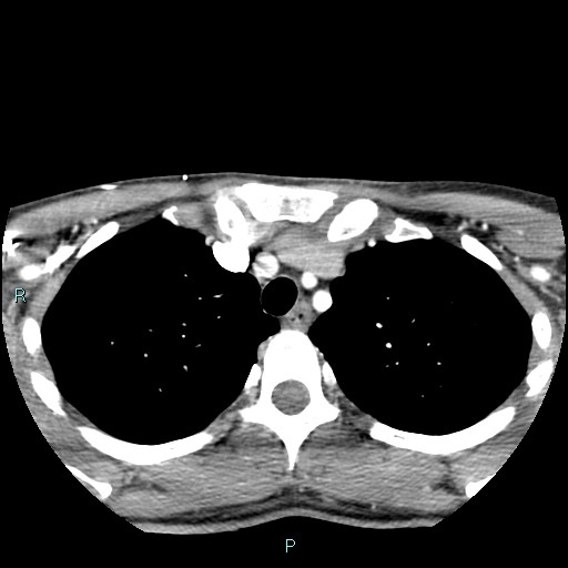 Cervical thymic cyst (Radiopaedia 88632-105335 B 12).jpg