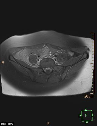 File:Cesarian scar endometriosis (Radiopaedia 68495-78066 Axial T1 C+ fat sat 1).jpg