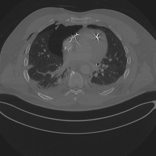 Chest multitrauma - aortic injury (Radiopaedia 34708-36147 Axial bone window 172).png