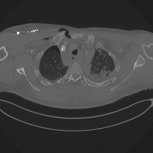 Chest multitrauma - aortic injury (Radiopaedia 34708-36147 Axial bone window 60).png
