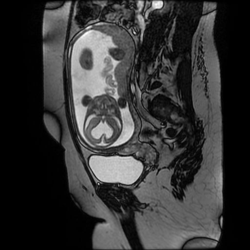 Chiari II malformation - fetal MRI (Radiopaedia 68099-77581 Sagittal Fiesta 23).jpg
