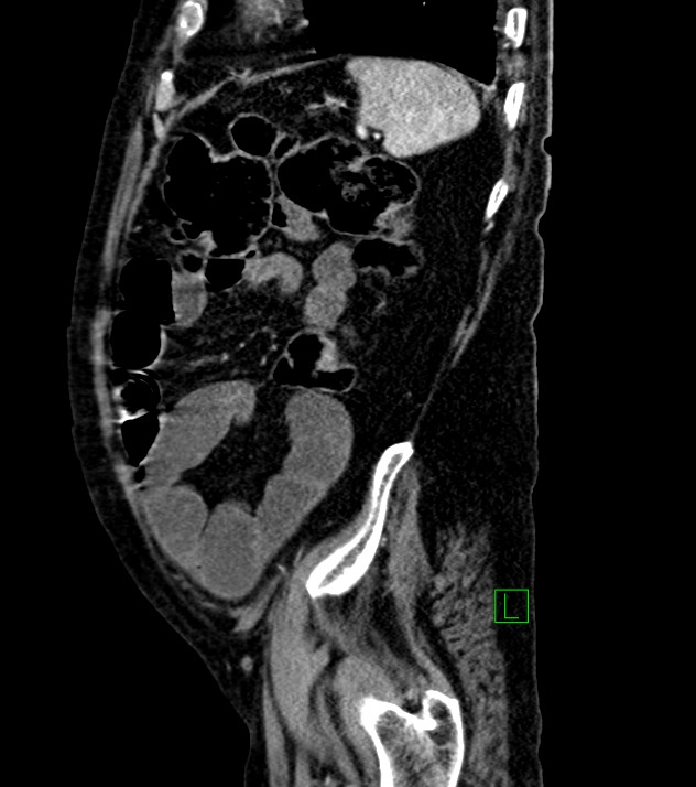 Cholangiocarcinoma with cerebral metastases (Radiopaedia 83519-98629 F 28).jpg