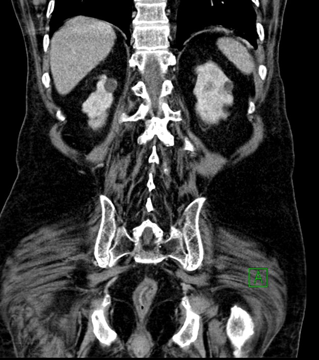 Cholangiocarcinoma with cerebral metastases (Radiopaedia 83519-98629 G 64).jpg