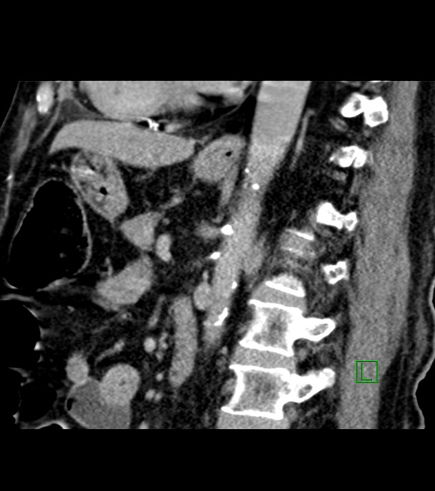 Cholangiocarcinoma with cerebral metastases (Radiopaedia 83519-98629 Sagittal C+ delayed 49).jpg
