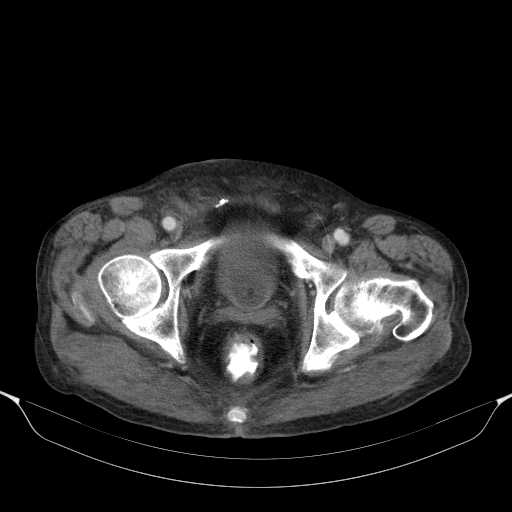 File:Cholangitis and abscess formation in a patient with cholangiocarcinoma (Radiopaedia 21194-21100 A 48).jpg