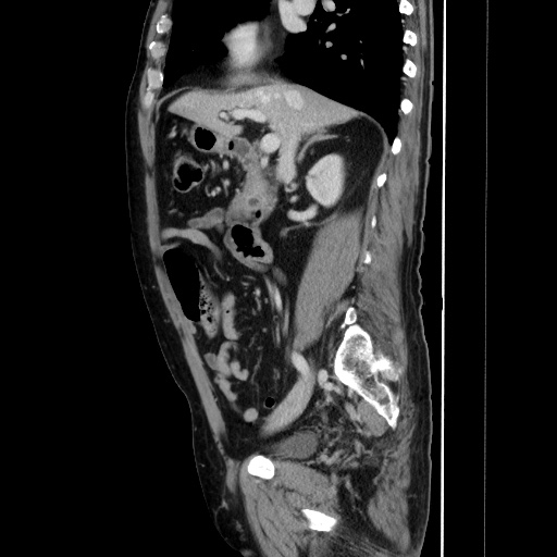Choledocholiathiasis with normal caliber common bile duct (Radiopaedia 75368-86632 D 68).jpg