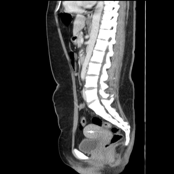 Choledocholithiasis on CT and MRI (Radiopaedia 24825-25087 D 35).jpg