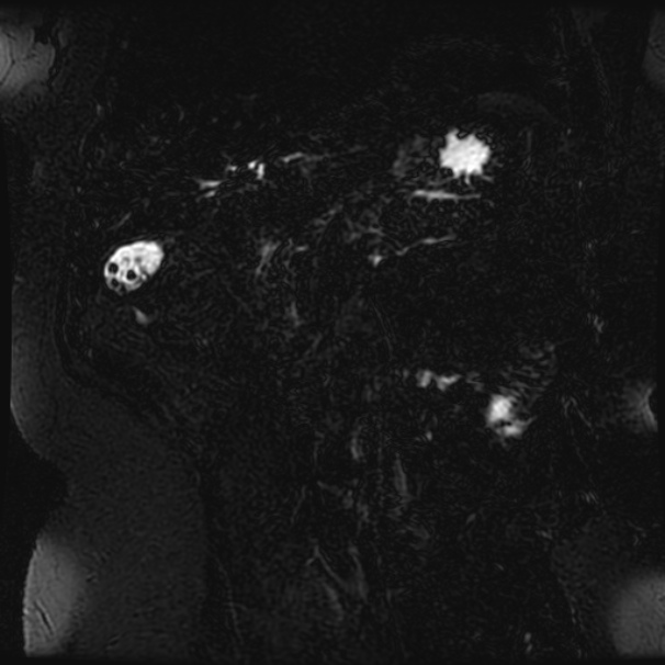 Choledocholithiasis on CT and MRI (Radiopaedia 24825-25088 Coronal T2 62).jpg