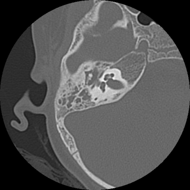 Cholesteatoma (Radiopaedia 73023-83750 Axial Right ear 43).jpg