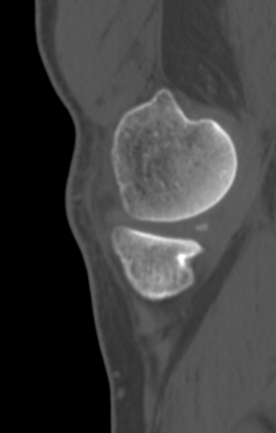 Chondrocalcinosis (Radiopaedia 82862-97173 Sagittal bone window 9).jpg