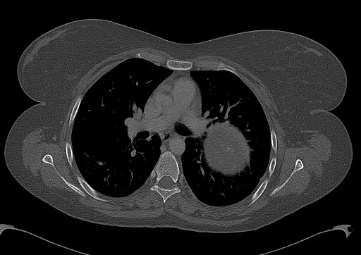 Chondrosarcoma - chest wall (Radiopaedia 65192-74199 Axial bone window 54).jpg