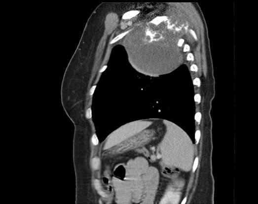 Chondrosarcoma - chest wall (Radiopaedia 65192-74199 B 15).jpg