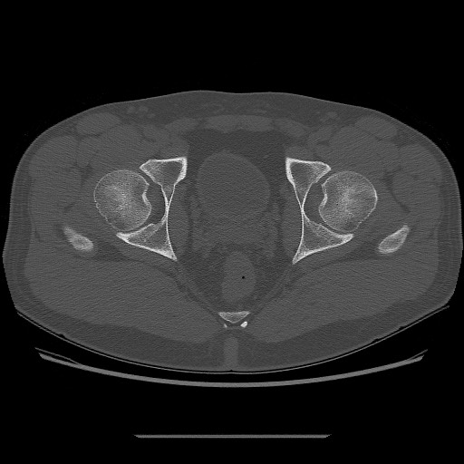 File:Chondrosarcoma of iliac wing (Radiopaedia 63861-72599 Axial bone window 102).jpg