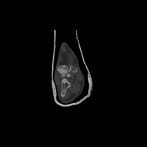 File:Chopart fracture (Radiopaedia 12386-12650 Coronal bone window 6).jpg