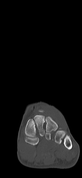 Chopart fracture (Radiopaedia 35347-36851 Coronal bone window 53).jpg