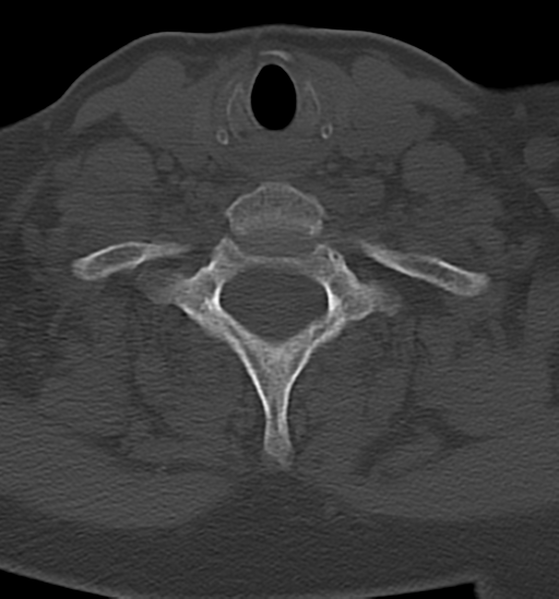 Chordoma (C4 vertebra) (Radiopaedia 47561-52188 Axial bone window 40).png